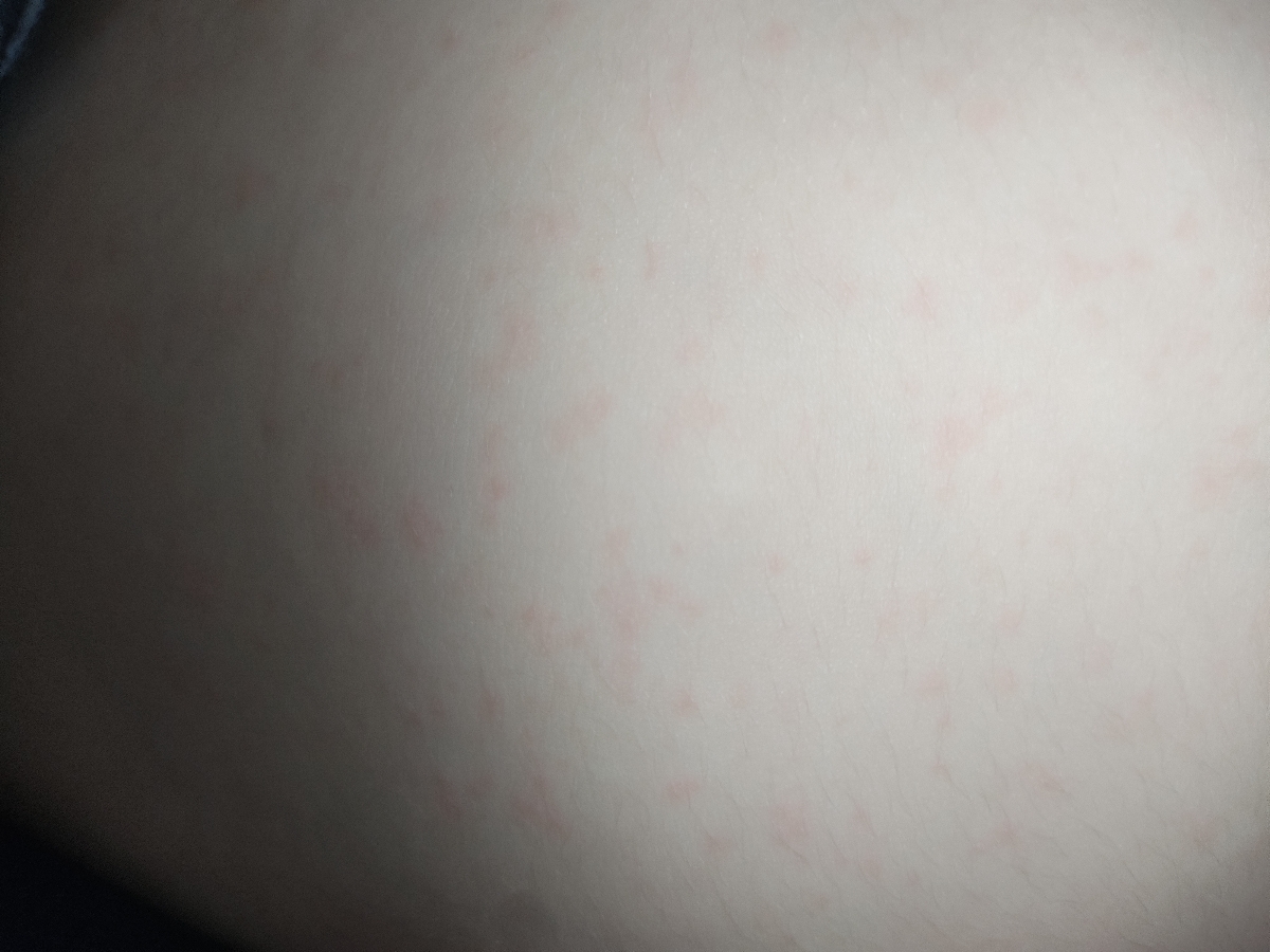 ❌مامانا بیاین کمک.این رزوئلاس یا ویروس دست پا و دهان؟؟❌