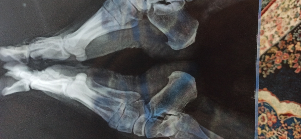 عکس رادیولوژی پاشنه پا