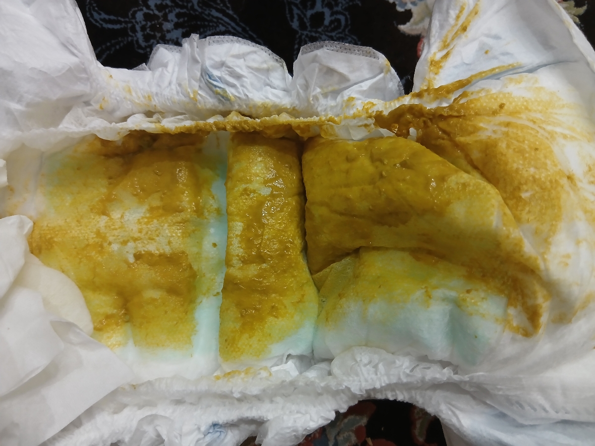 بد کار کردن شکم بعد از واکسن همراه عکس .. بد کار کردن شکم بعد از واکسن همراه عکس ..