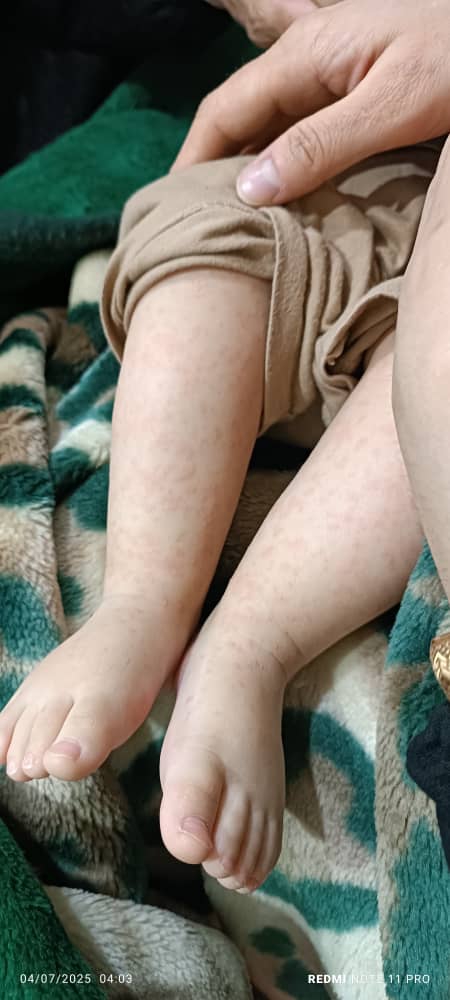 ❌مامانا بیاین کمک.این رزوئلاس یا ویروس دست پا و دهان؟؟❌