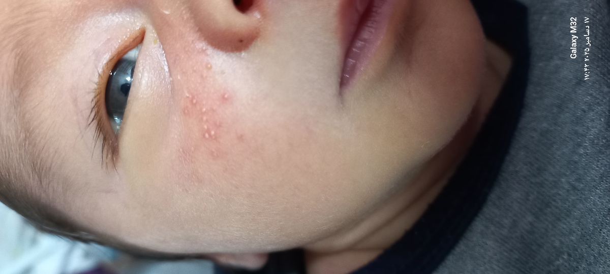 دانه‌های ریز اطراف بینی قرمز رنگ