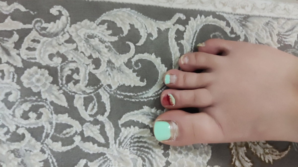 ضربه خوردن و درآمدن ناخن( عکس)