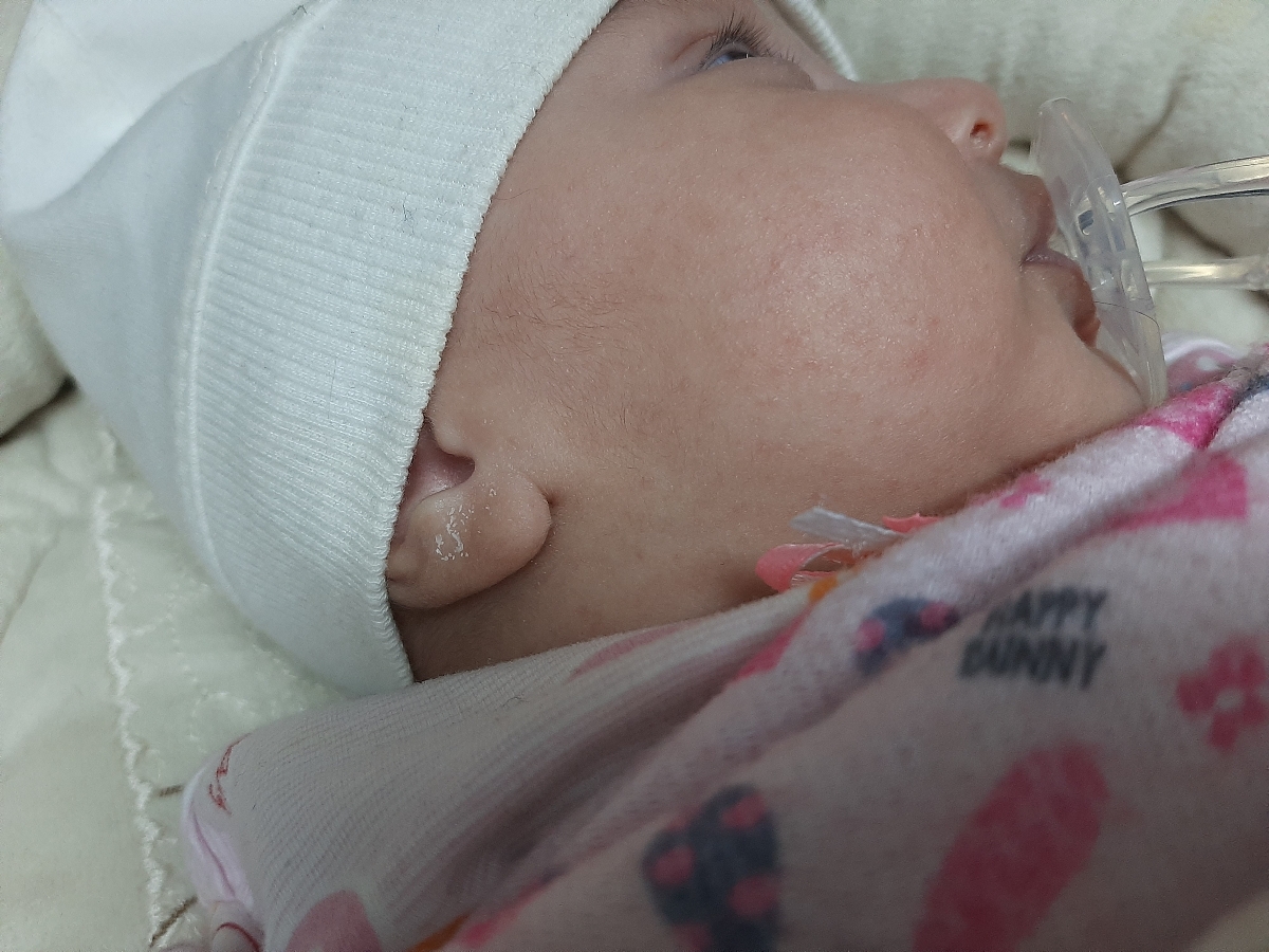 جوش صورت نوزادم خطرناکه؟