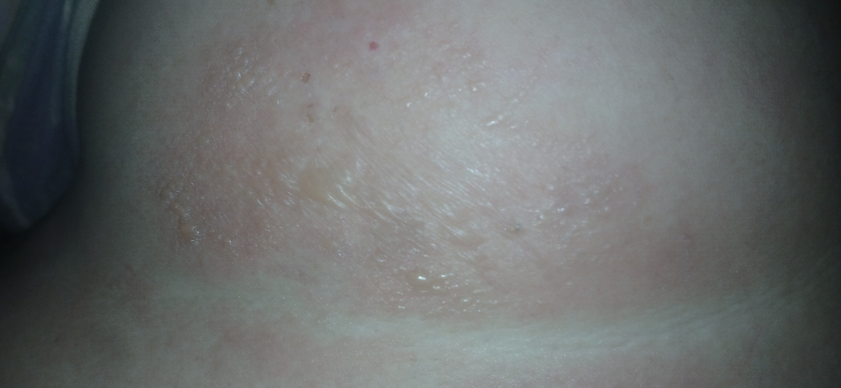 توال پوستی روی کمر دکتر جان