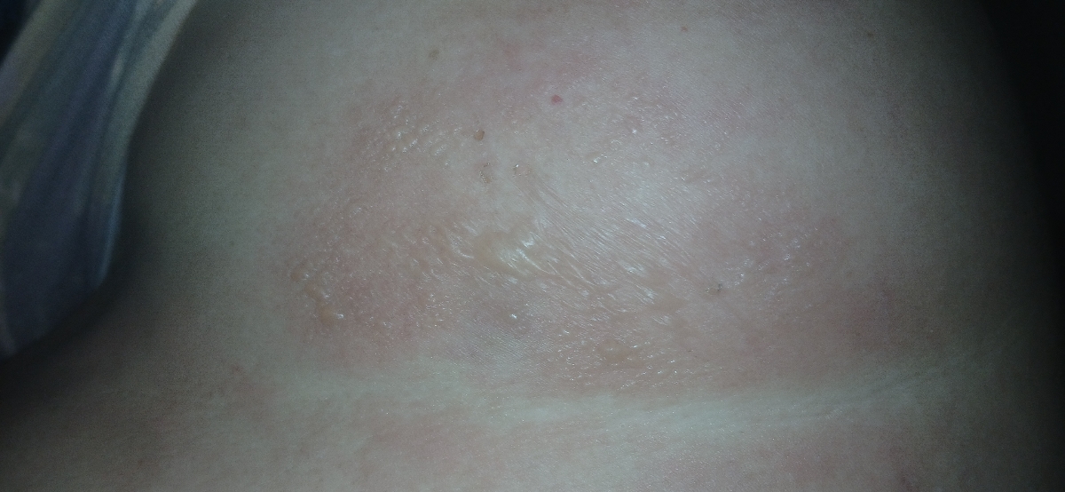 توال پوستی روی کمر دکتر جان