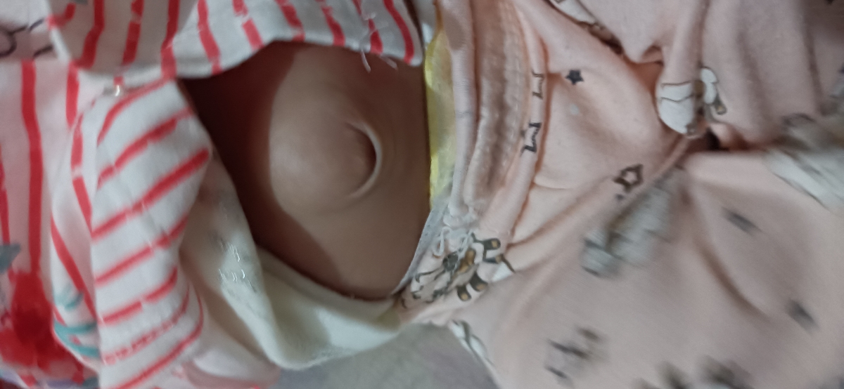 ناف نوزاد ۴۸روزم بیرون زدست