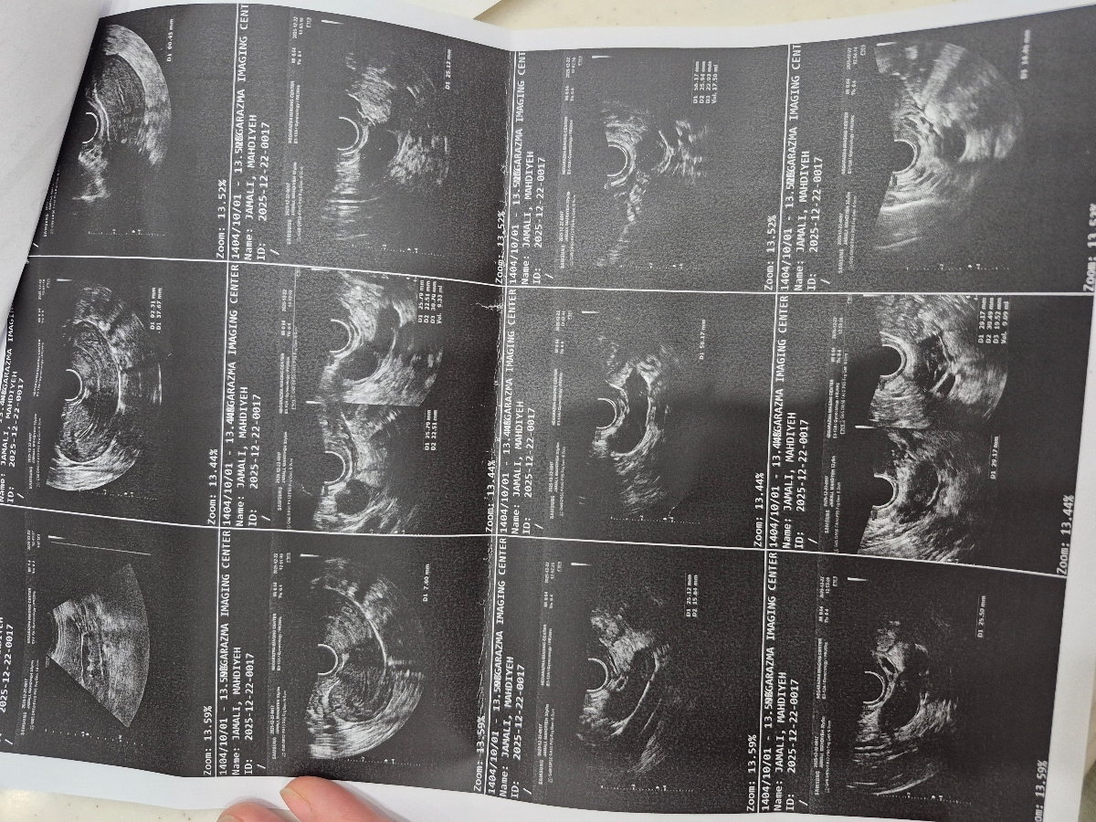 با این فولیکول کی آمپول رو بزنم؟؟؟