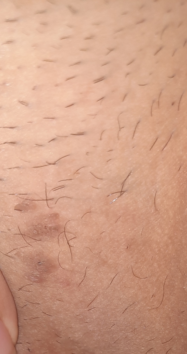 ضایعه پوستی. زگیل تناسلی