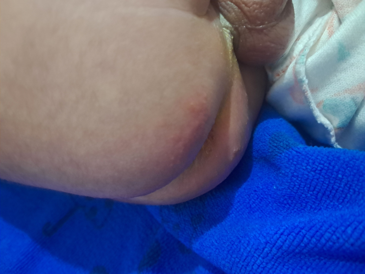 سوختگی مقعد نوزاد