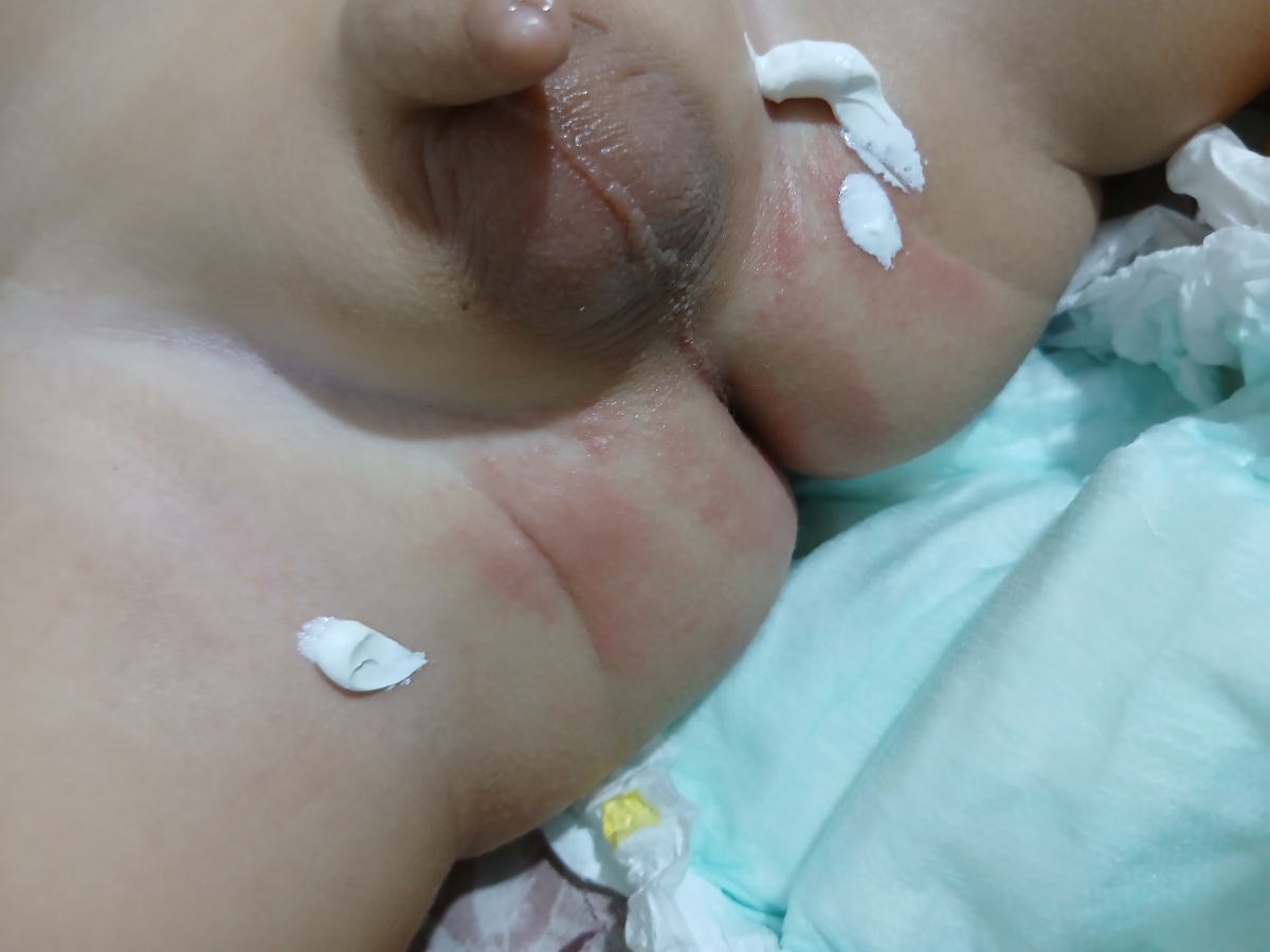 اینجوری شده
زینک اکساید میزنم فایده نداره
چی استفاده کنم