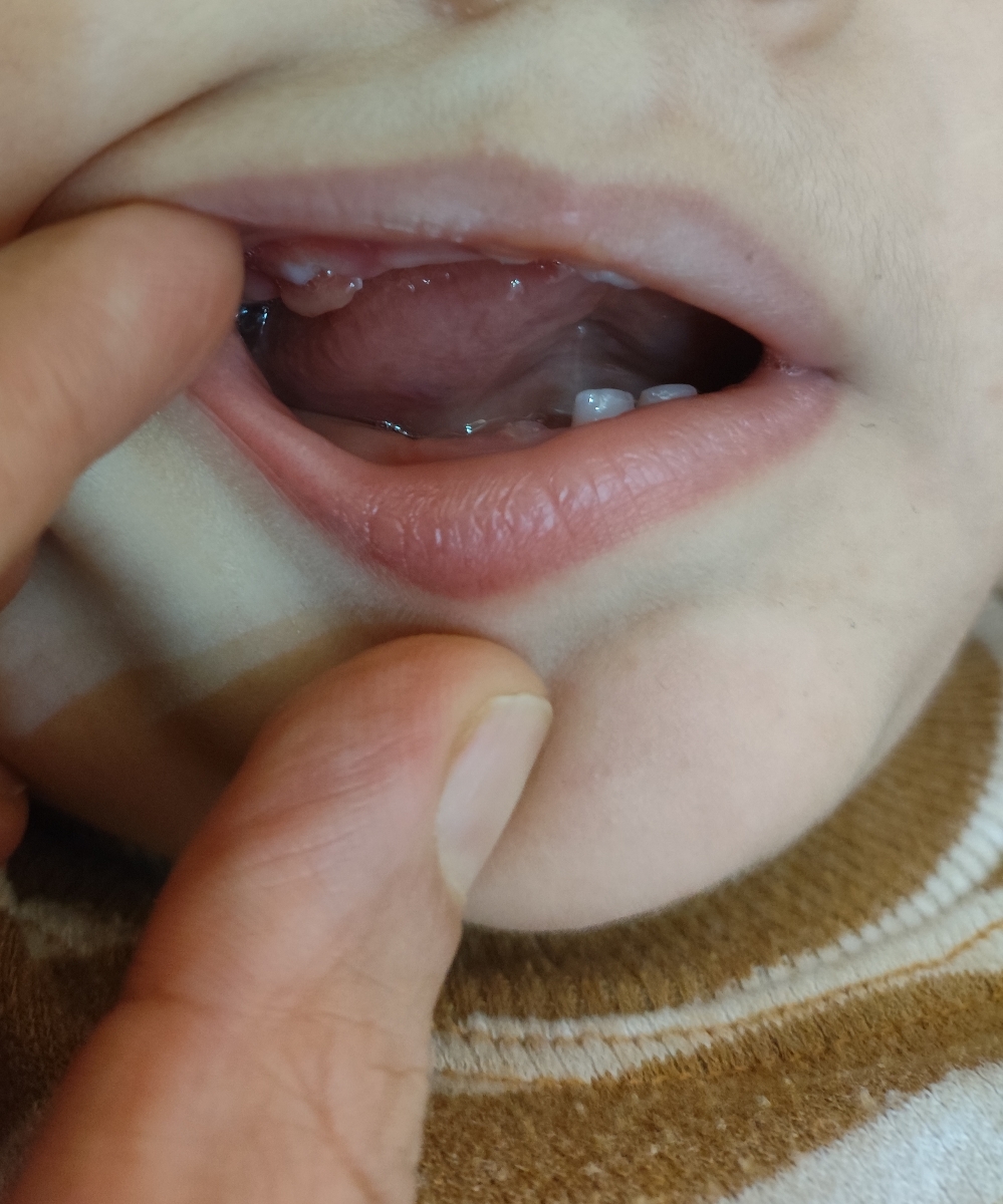 دندان های شیری