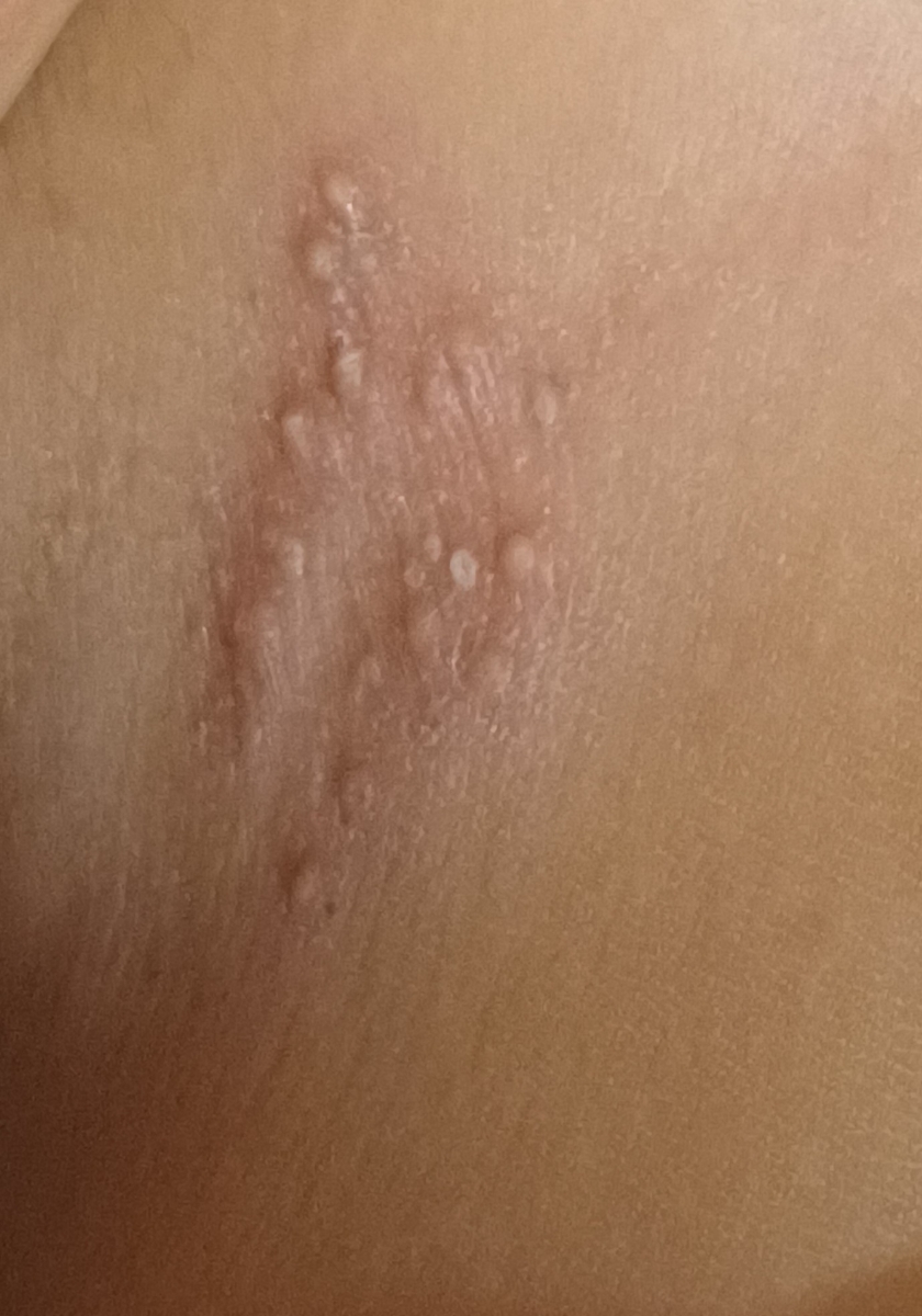 جوش های بغل کشاله ران