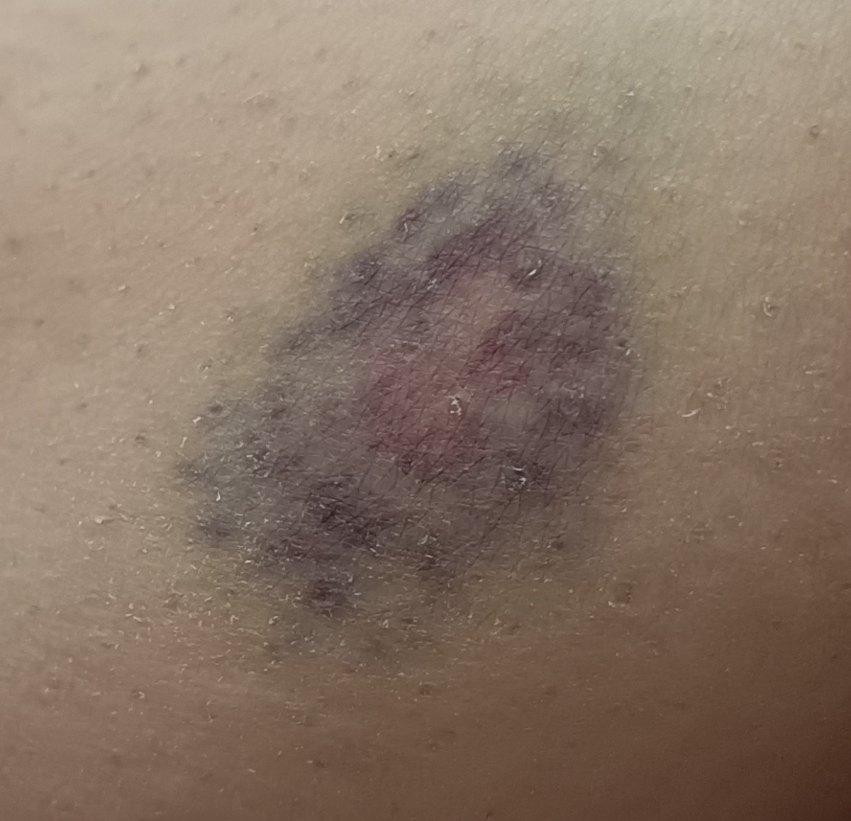 لک و کبودی روی پاها