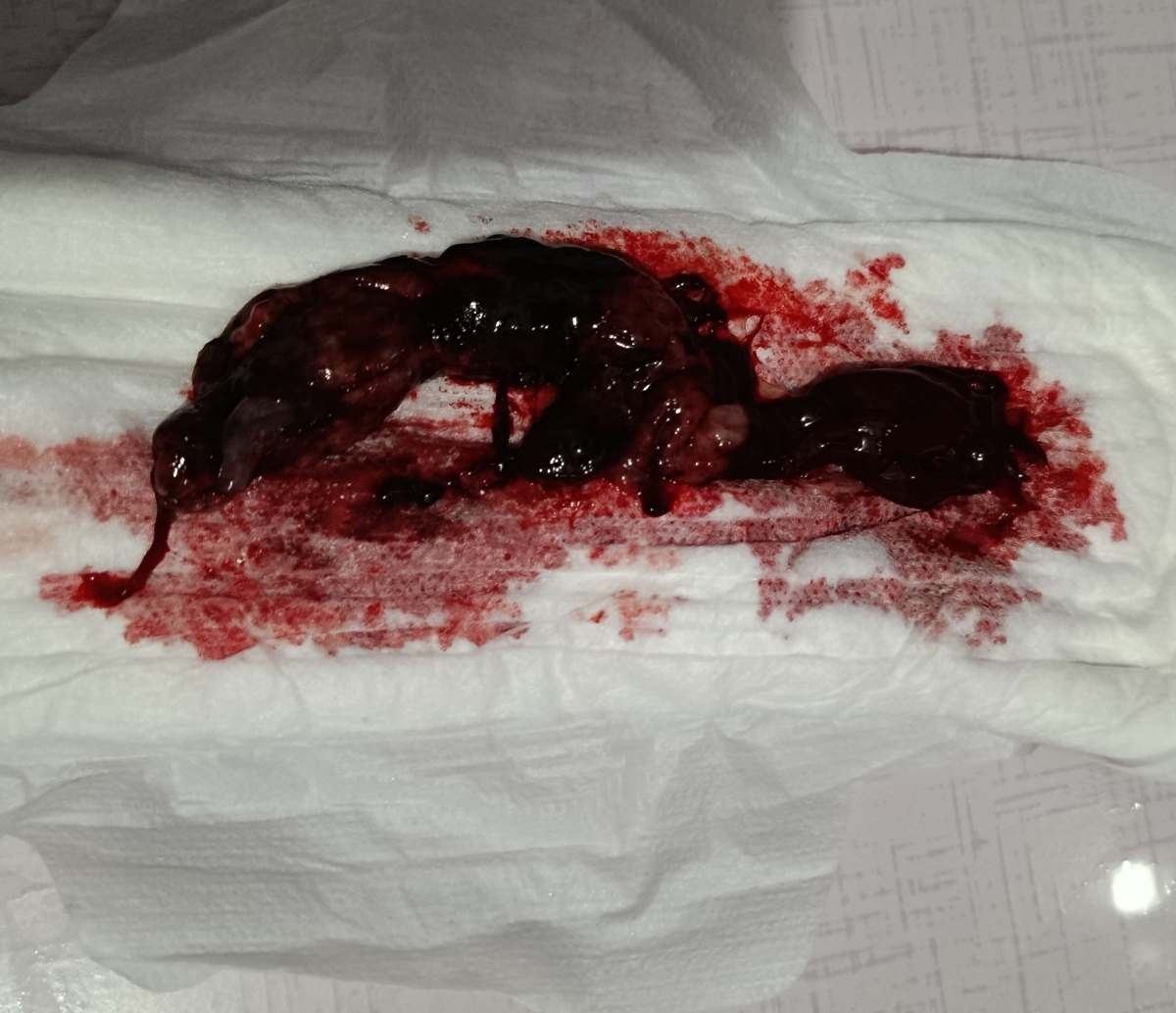 سونو گرافی(سقط+عکس لخته ) لطفاً اگر بدتان میاد باز نکنید