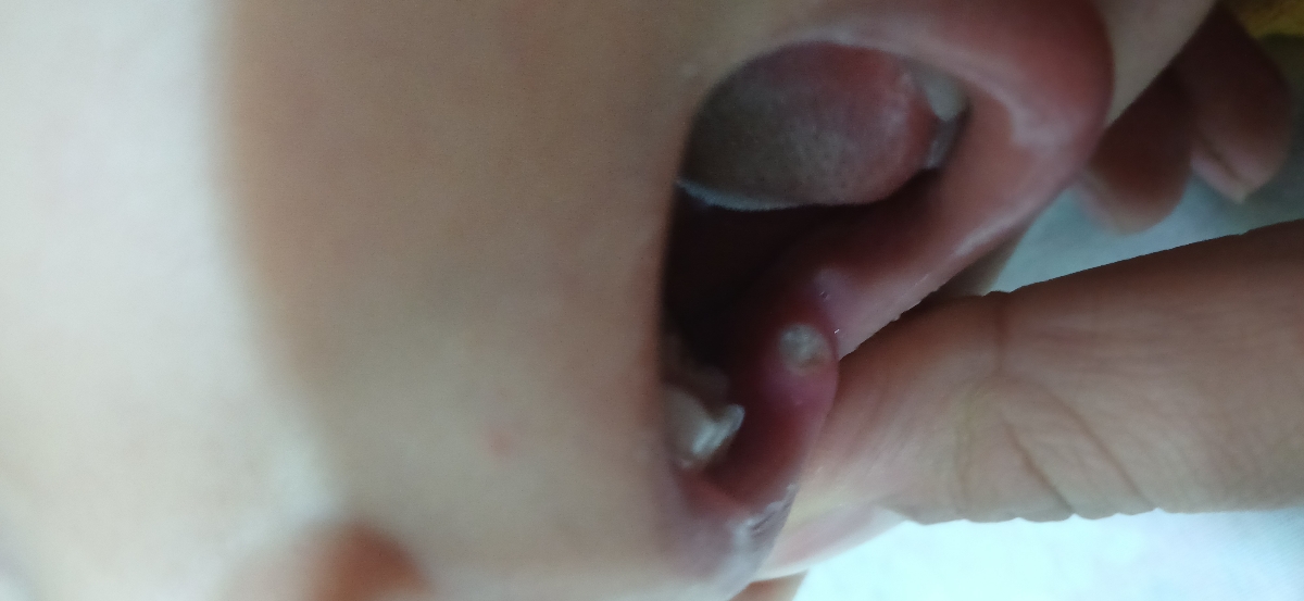 علت زخم دهان از چیه