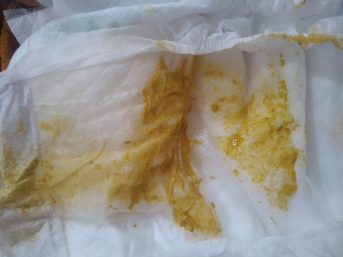 سلام وقتتون بخیر اسهال نوزاد ۴۵روزه سلام وقتتون بخیر اسهال نوزاد ۴۵روزه