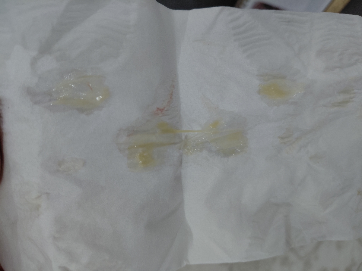 گرفتگی بینی نوزاد ۴ماهه