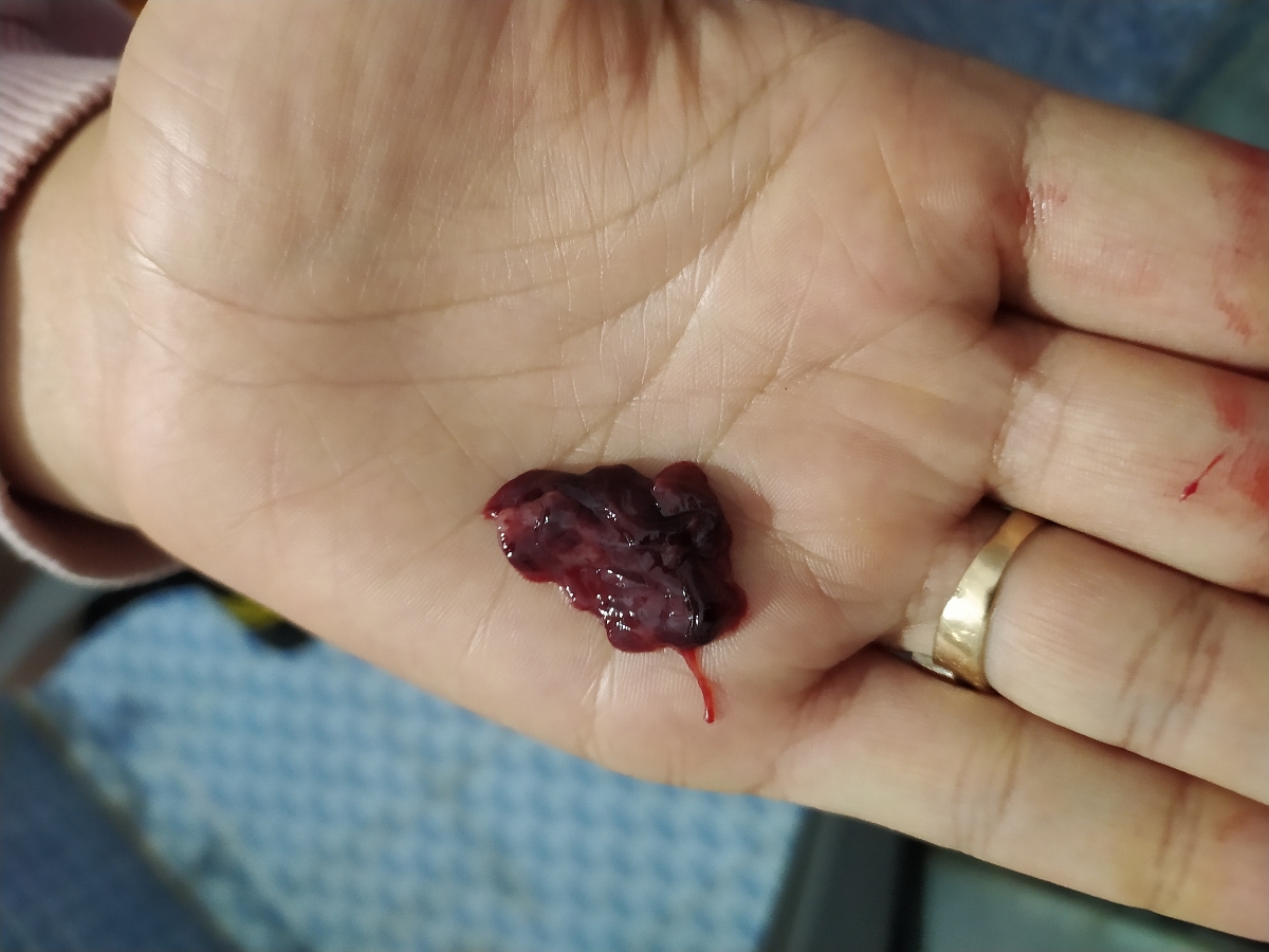 غیر از این چیزی دفع نکردم بعدش فقط خونریزی در حد پریود دارم