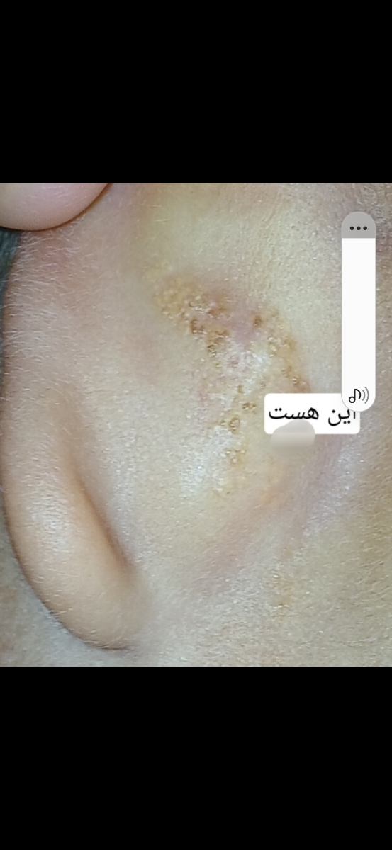 زخم پشت گوش از بچگی
