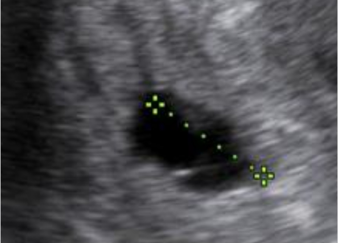 این عکس سونو نگاه کنید دکتر خالیه واقعا جنین کامل جذب شده؟