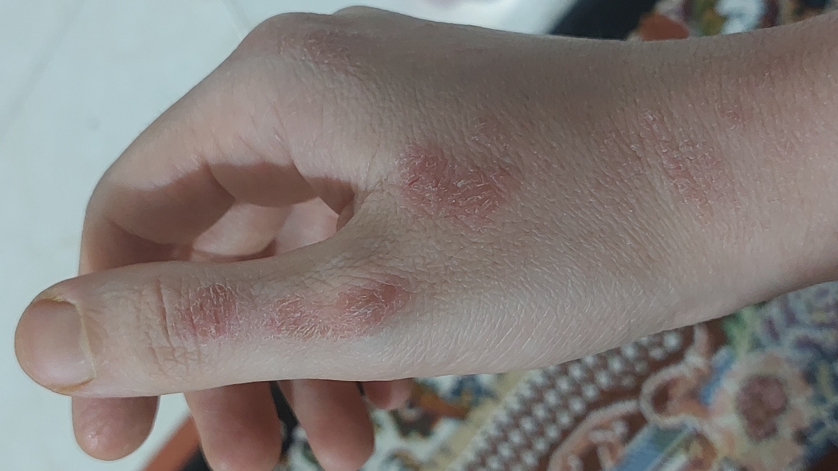 خشکی شدید پوست دست