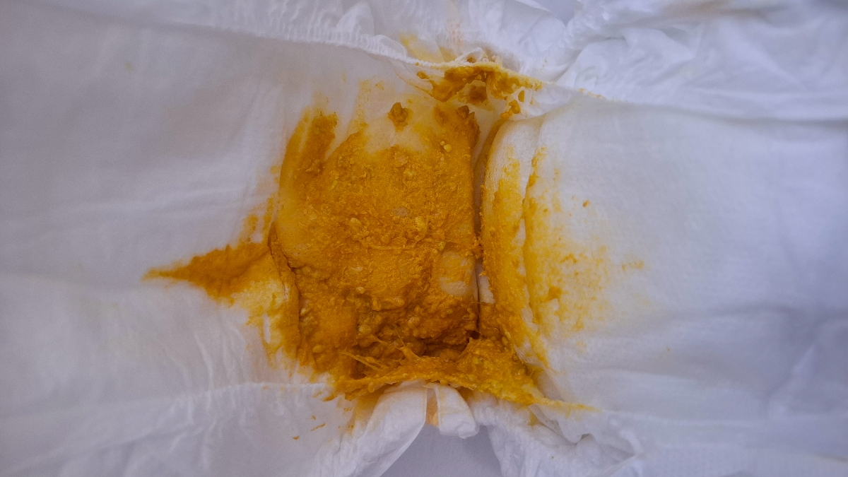 قرمز شدن آلت نوزاد پسر قرمز شدن آلت نوزاد پسر