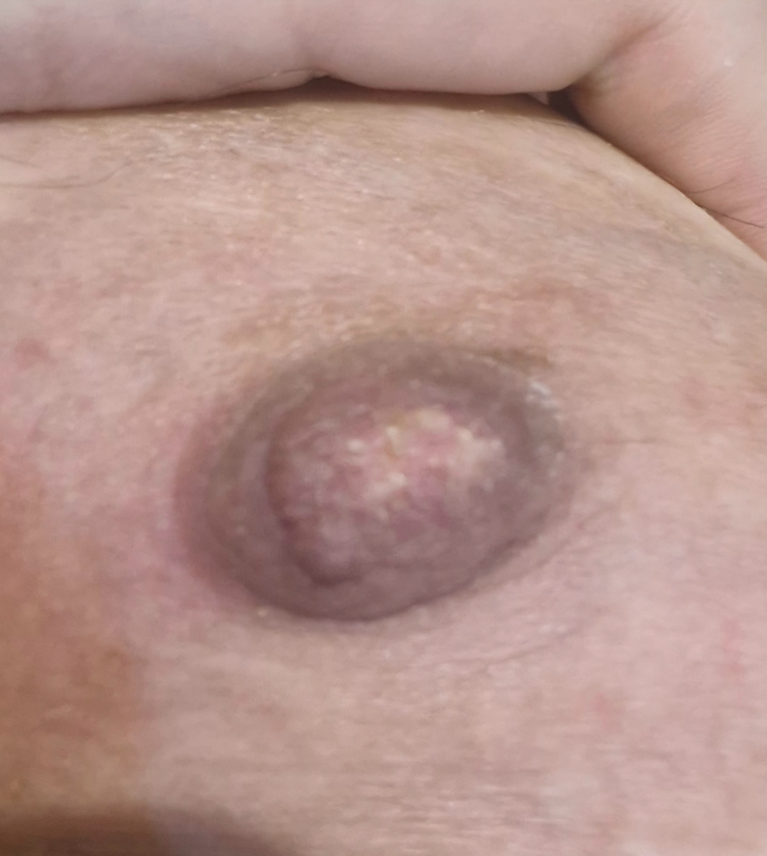 سفیدی نوک سینه