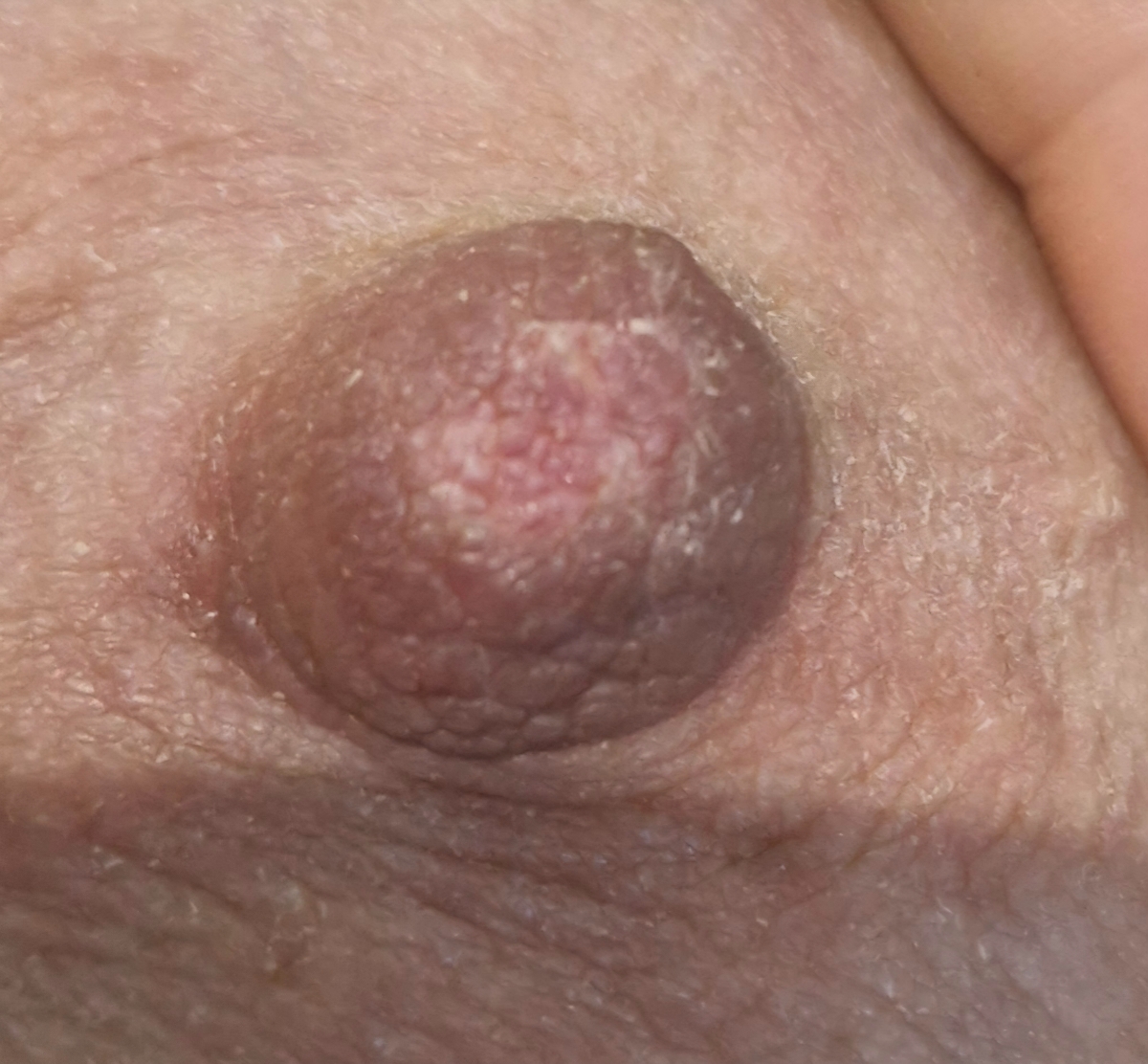 سفیدی نوک سینه