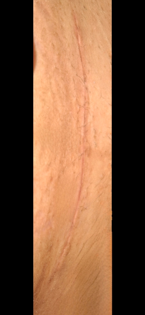 جای بخیه هام این مدلی هست از روز ۱۰ میموزا زدم از روز ۱۴ ژلیورس 