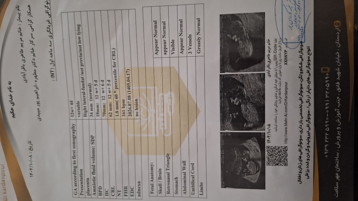 ریسک سندروم داون ازمایش ان تی