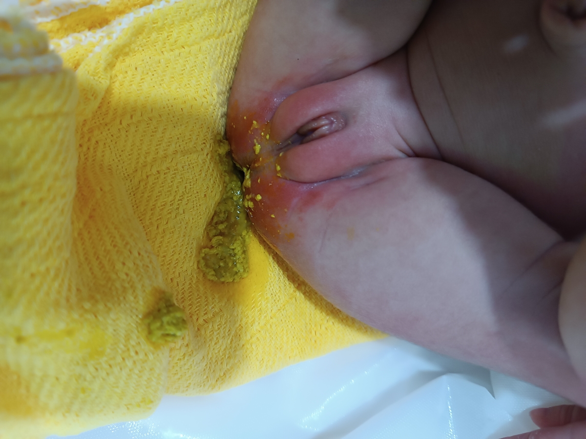 اسهال بودن نوزاد 9 روزه