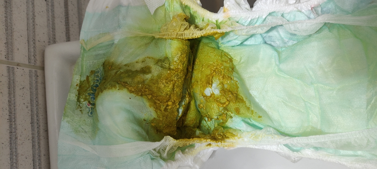 سوختگی پای نوزاد ۳ ماهه سوختگی پای نوزاد ۳ ماهه