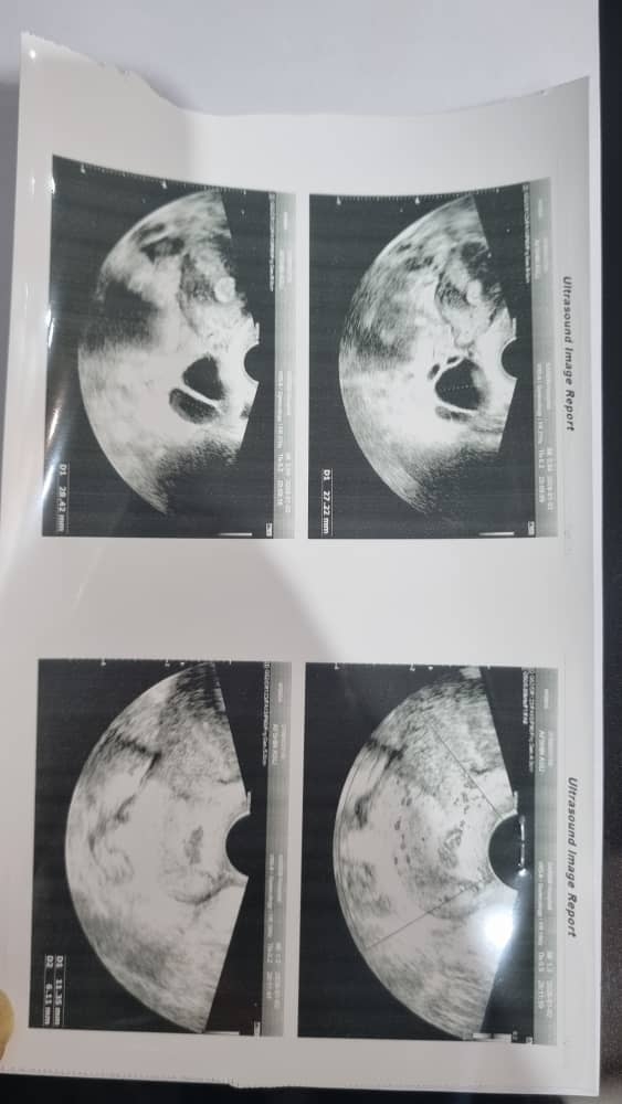 سونو تخمدان و رحم