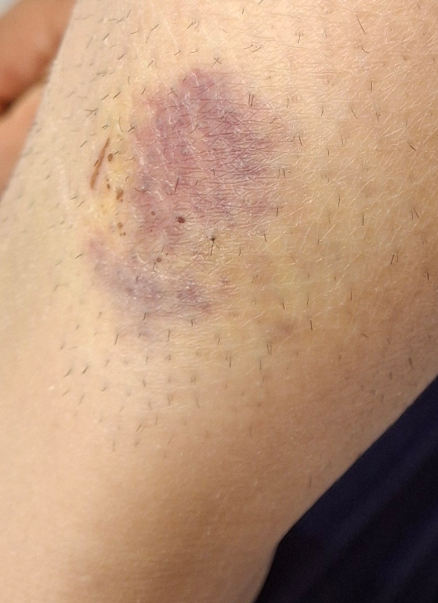 جای کبودی و همراه با درد خانم دکتر