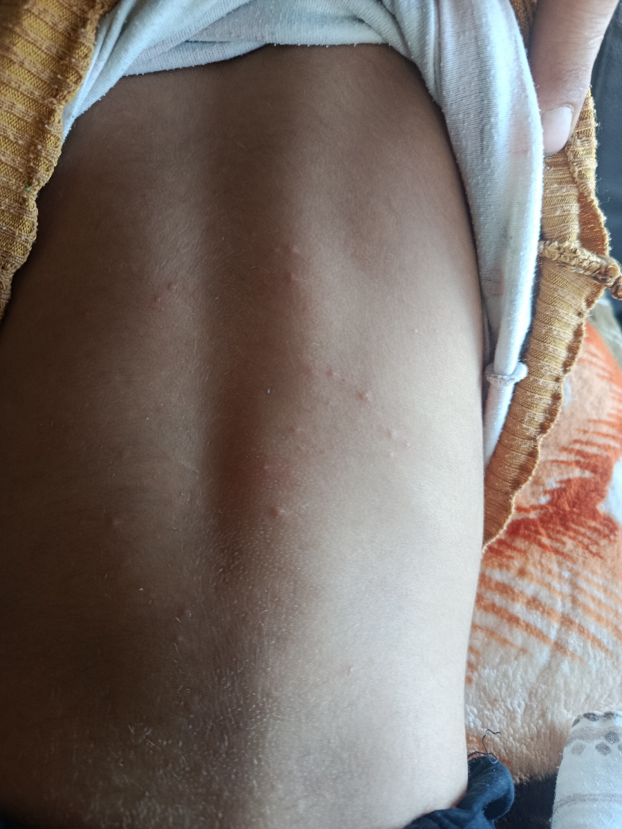 این دونه های روی بدن دخترم چیه