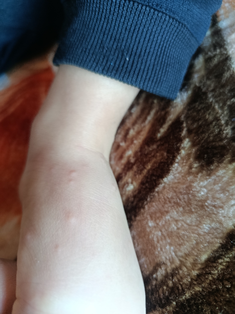 این دونه های روی بدن دخترم چیه