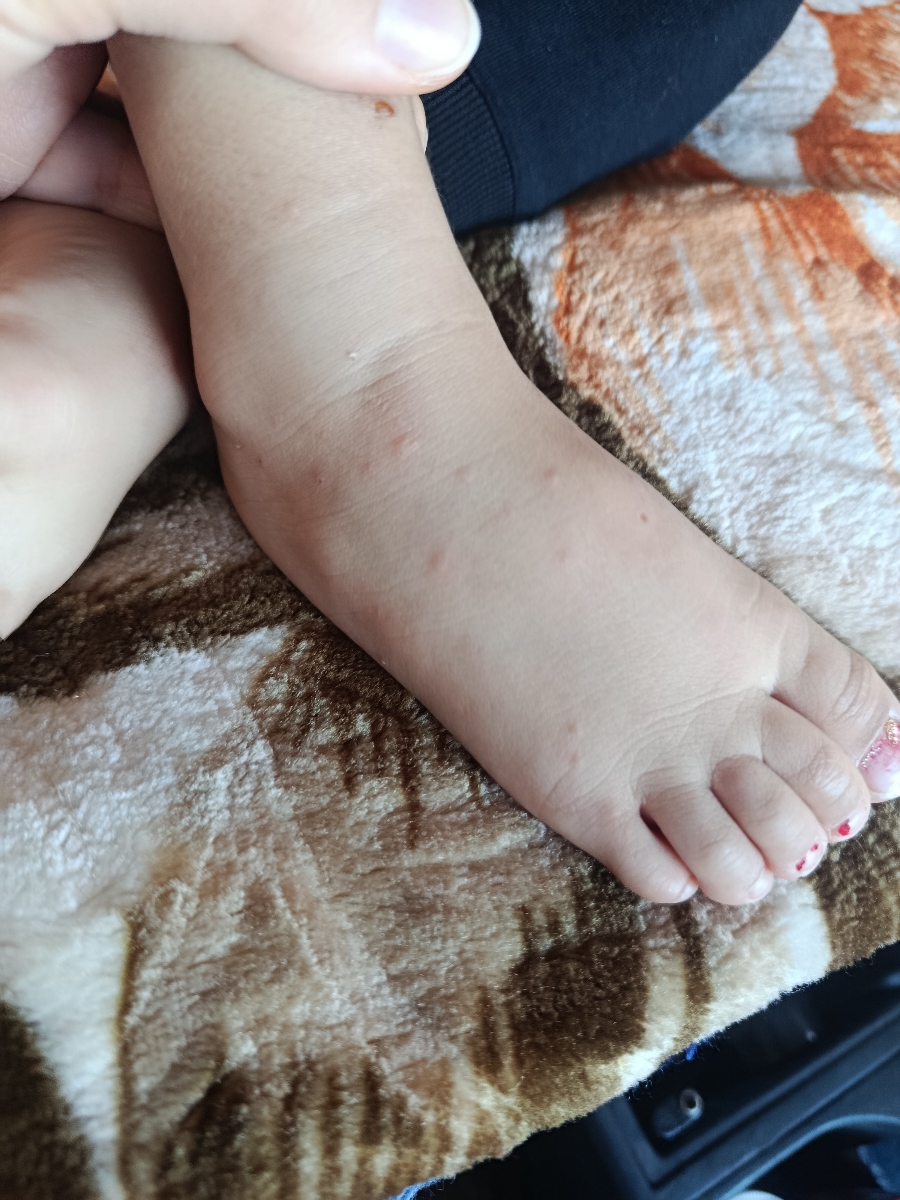 این دونه های روی بدن دخترم چیه