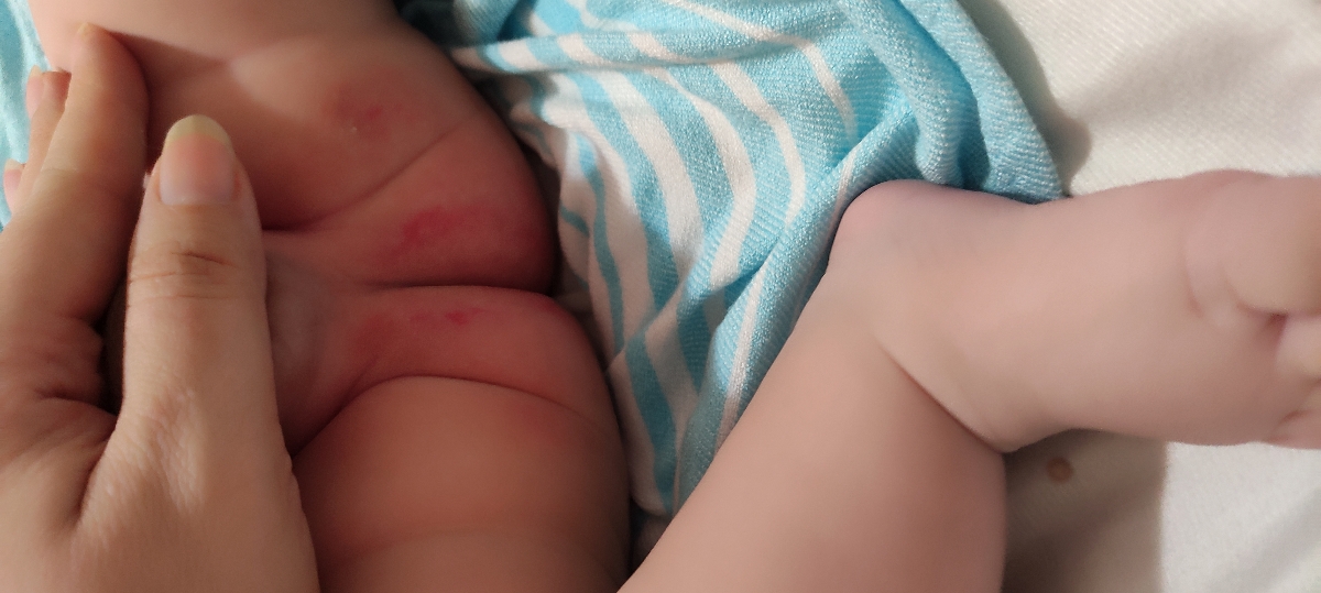 سوختگی پای نوزاد ۳ ماهه سوختگی پای نوزاد ۳ ماهه