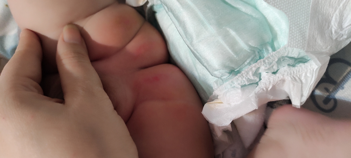 سوختگی پای نوزاد ۳ ماهه سوختگی پای نوزاد ۳ ماهه