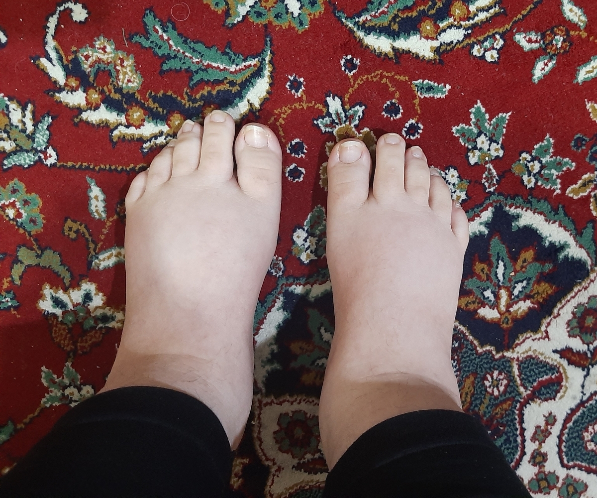 ورم پا بعد از سزارین