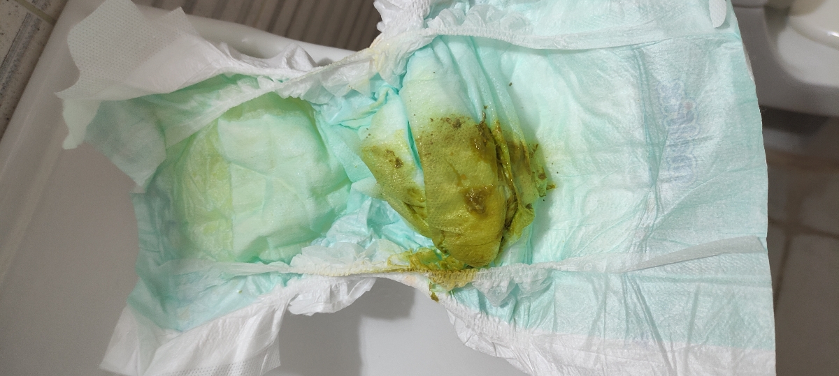 سوختگی پای نوزاد ۳ ماهه سوختگی پای نوزاد ۳ ماهه