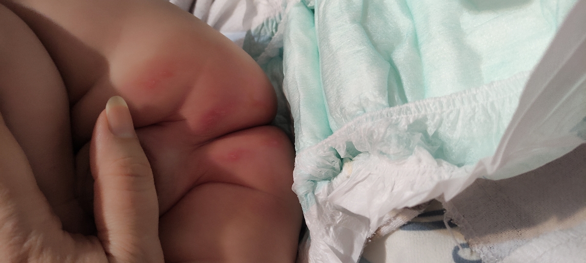 سوختگی پای نوزاد ۳ ماهه سوختگی پای نوزاد ۳ ماهه