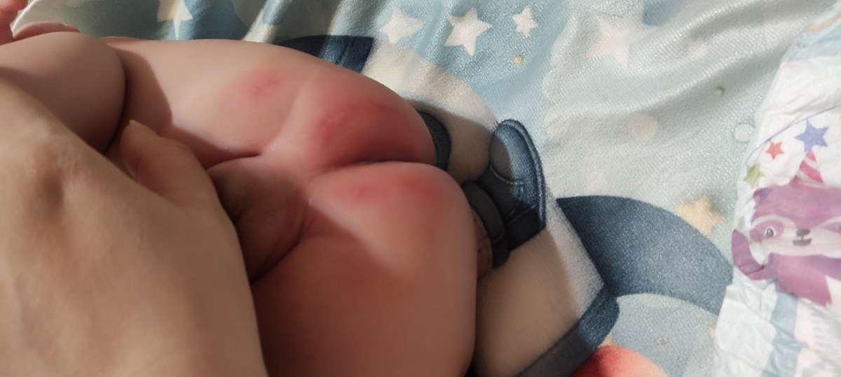 سوختگی پای نوزاد ۳ ماهه سوختگی پای نوزاد ۳ ماهه