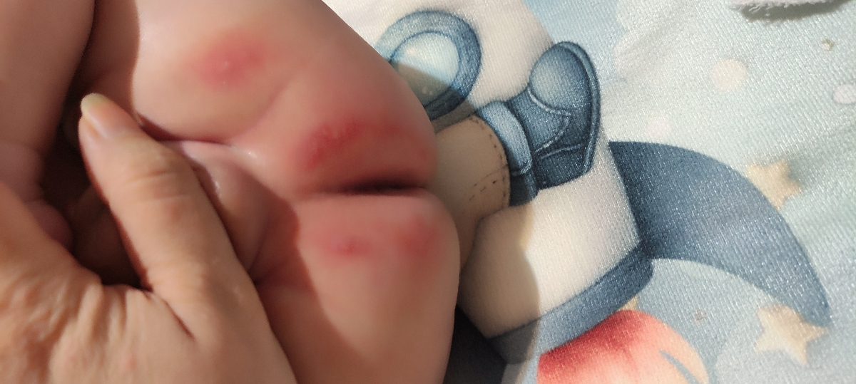 سوختگی پای نوزاد ۳ ماهه سوختگی پای نوزاد ۳ ماهه