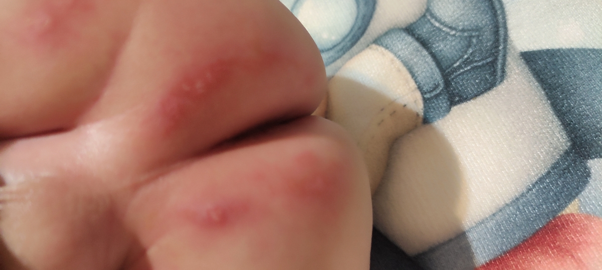 سوختگی پای نوزاد ۳ ماهه سوختگی پای نوزاد ۳ ماهه
