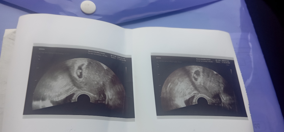 بارداری و ای وی اف و دوقلو شدن