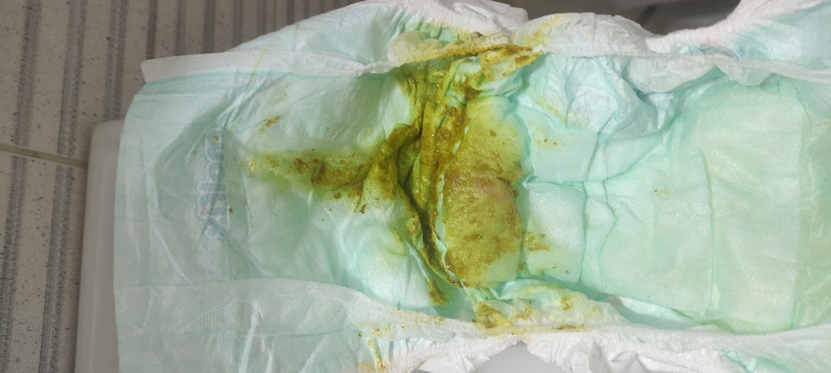 سوختگی پای نوزاد ۳ ماهه سوختگی پای نوزاد ۳ ماهه