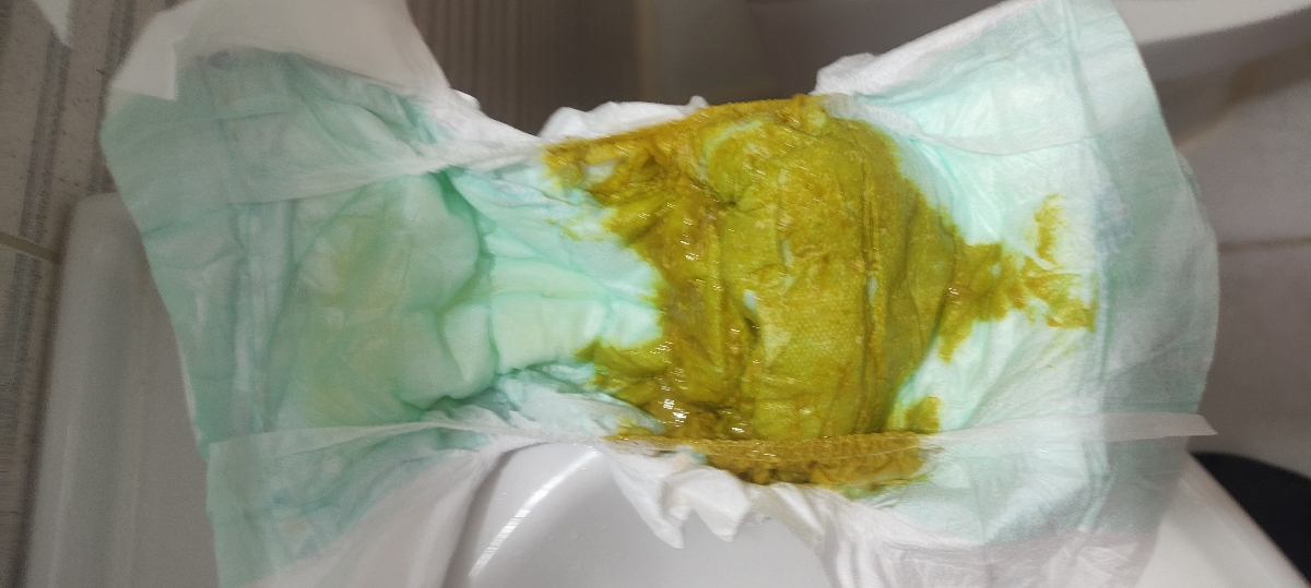 سوختگی پای نوزاد ۳ ماهه سوختگی پای نوزاد ۳ ماهه