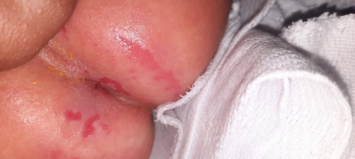 اسهال نوزاد و نخوردن شاسه او آر ای