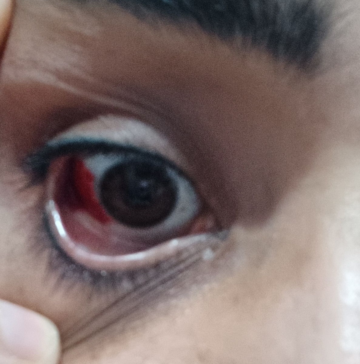 سرخی و قرمزی سفیدی چشم سرخی و قرمزی سفیدی چشم